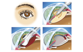 小樽市潮見台・小樽いのくち眼科・STEP2